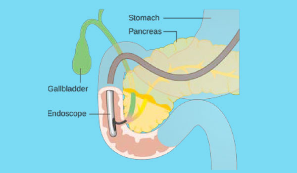 Endoscopic Retrograde Cholangiopancreatography (ERCP) and Endoscopic Ultrasound (EUS) are used to examine digestive, liver, bile duct and pancrease.