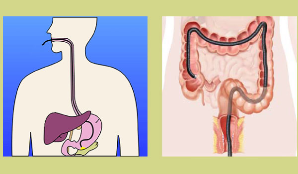 Endoscopy is a procedure that allows a doctor to directly examine the upper part of the digestive tract, which includes the esophagus stomach and the duodenum. Colonoscopy is an examination of the large intestines / colon.