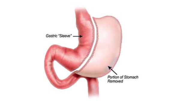 We perform; Gastric sleeve, mini gastric bypass,  gastric bypass, duodenal switch  and gastric balloon